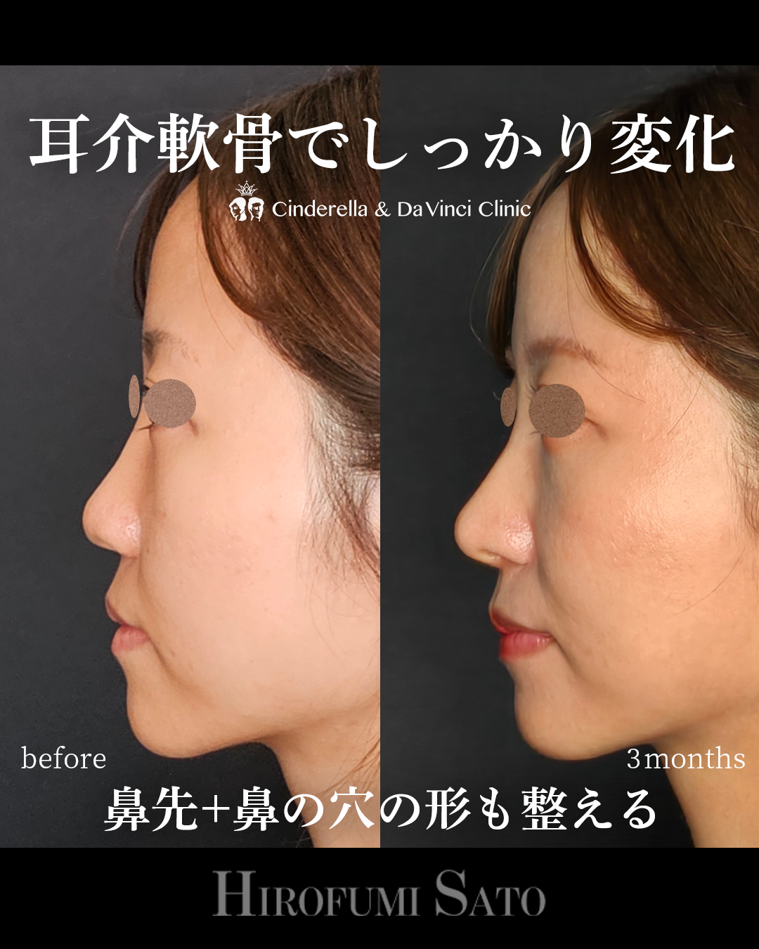 鼻の穴の形を整えるの画像