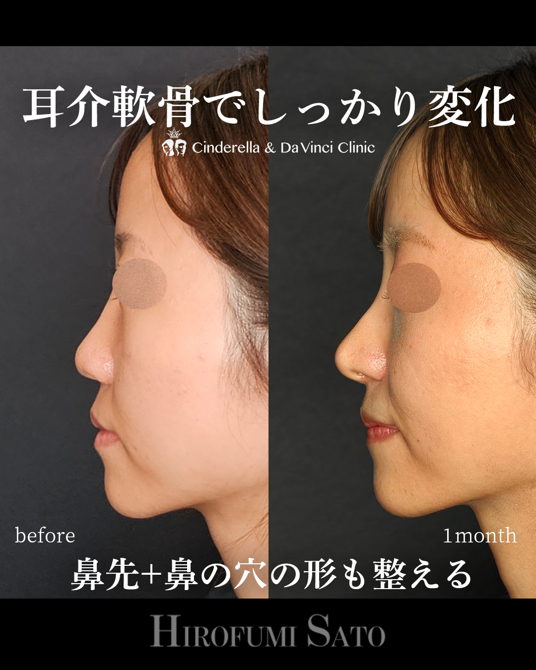鼻の穴の形を整えるの画像