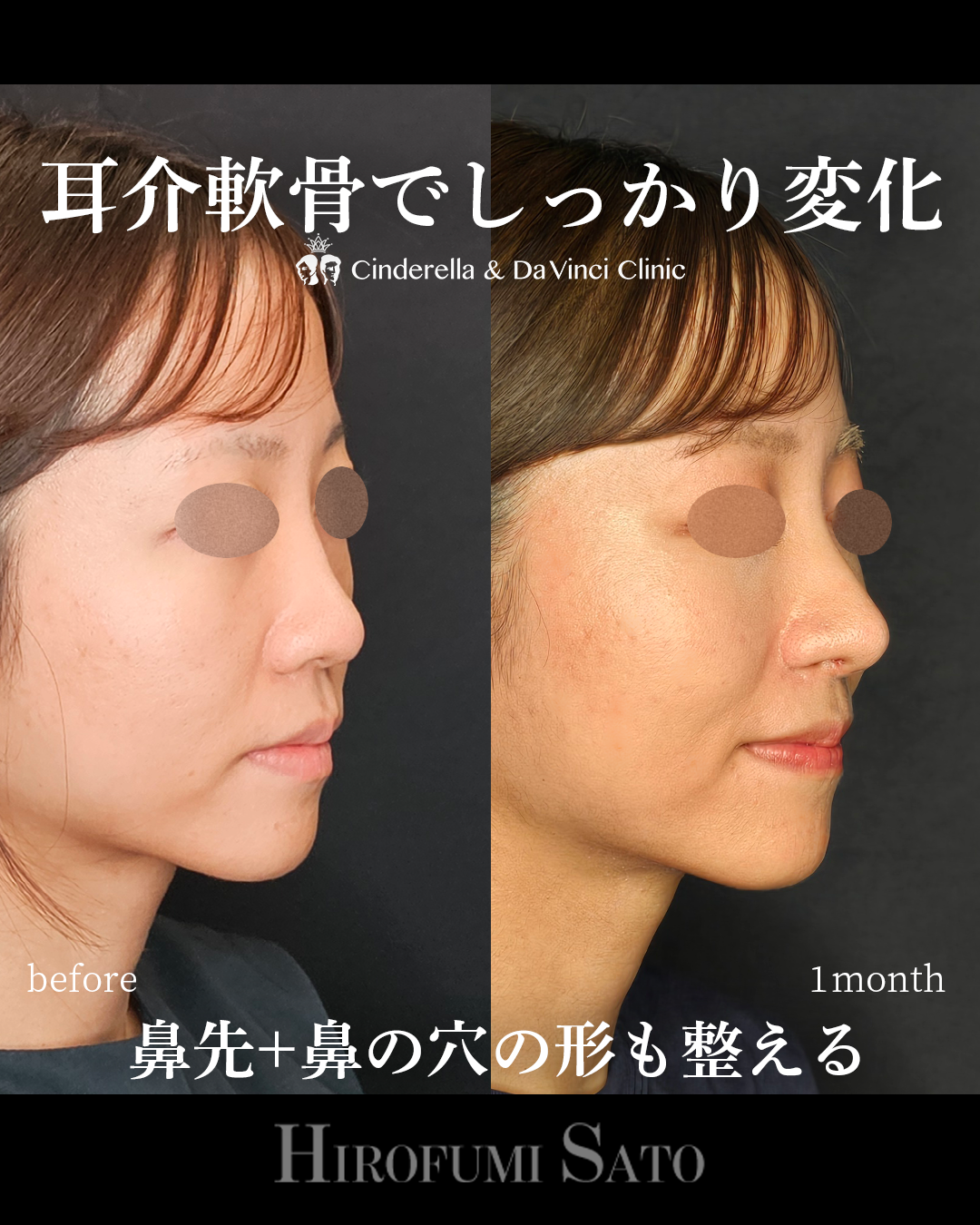鼻の穴の形を整えるの画像