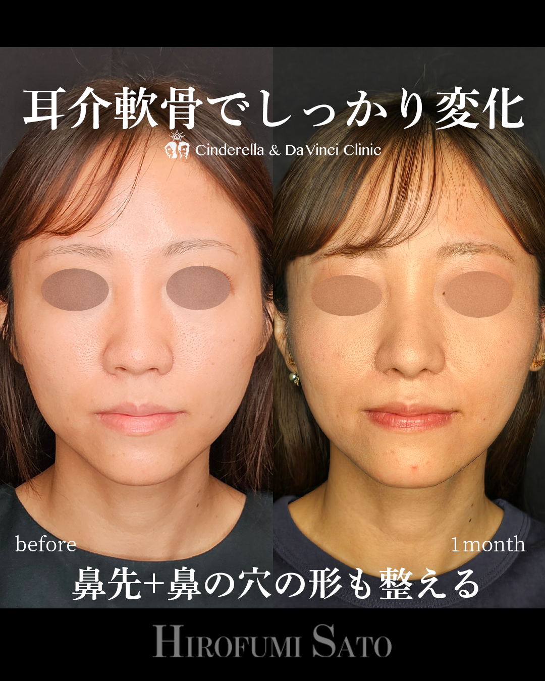 鼻の穴の形を整えるの画像
