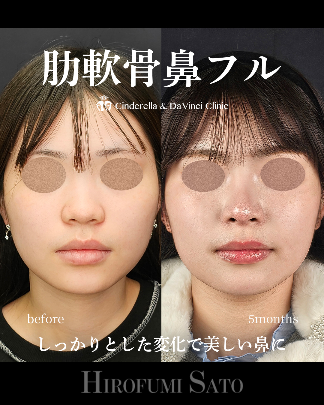 肋軟骨鼻フルの画像