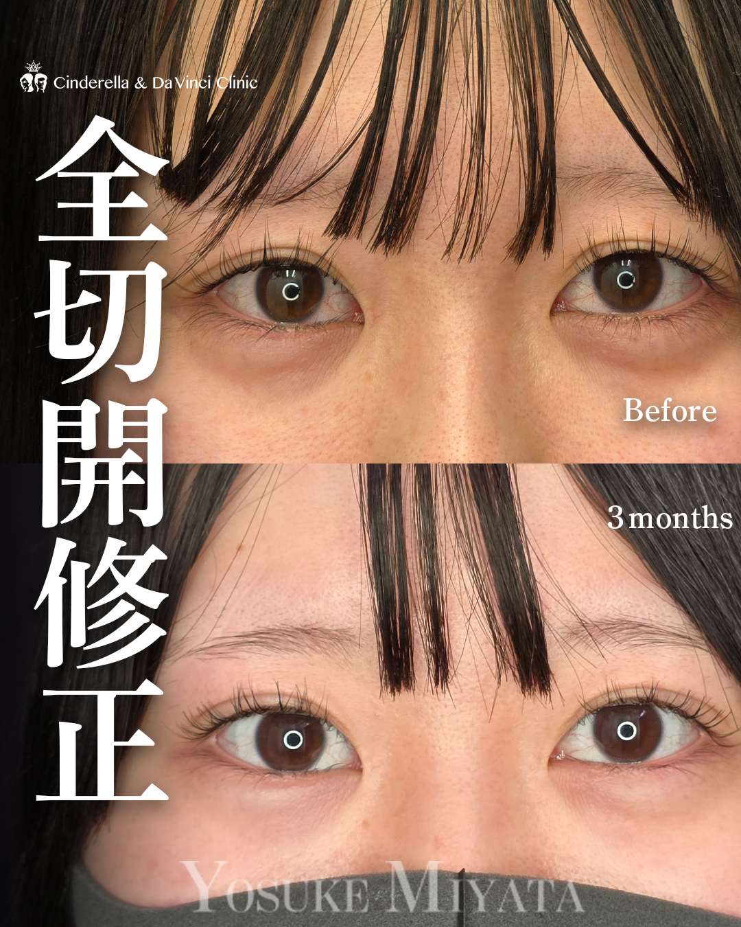 二重全切開の修正の画像