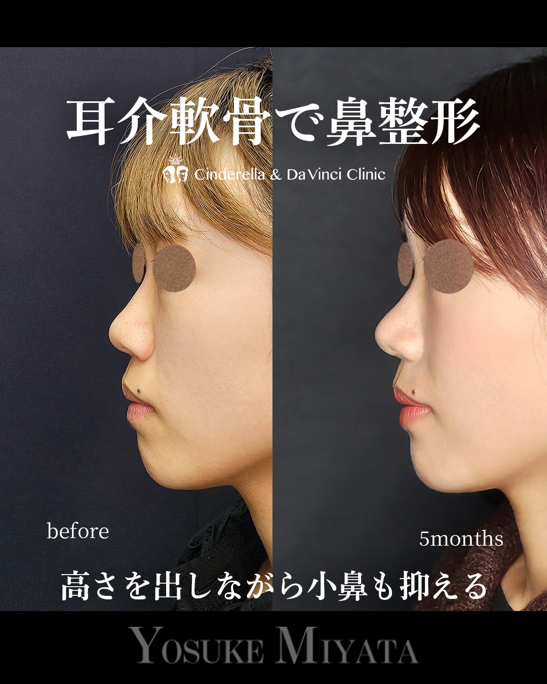 鼻全体に高さ出すの画像