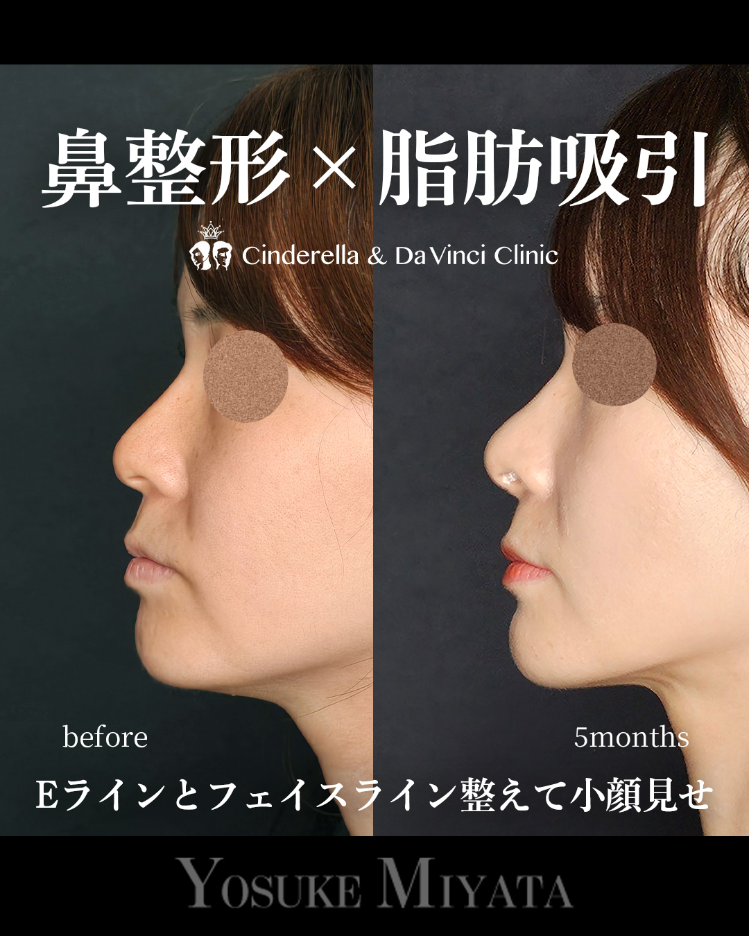 鼻整形と脂肪吸引の画像