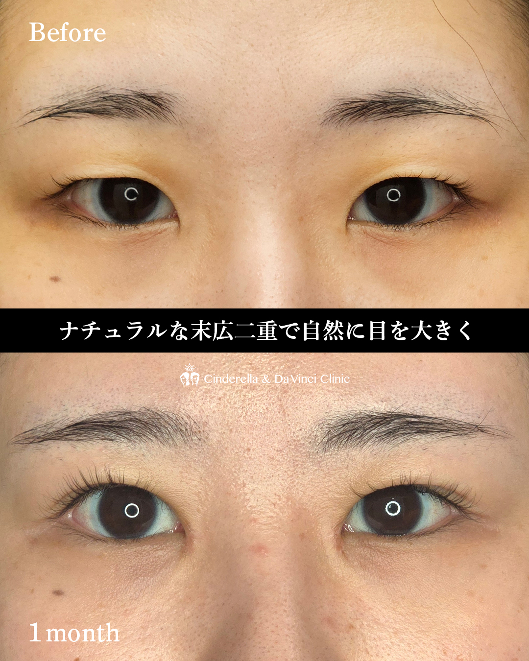目頭切開で末広二重の画像
