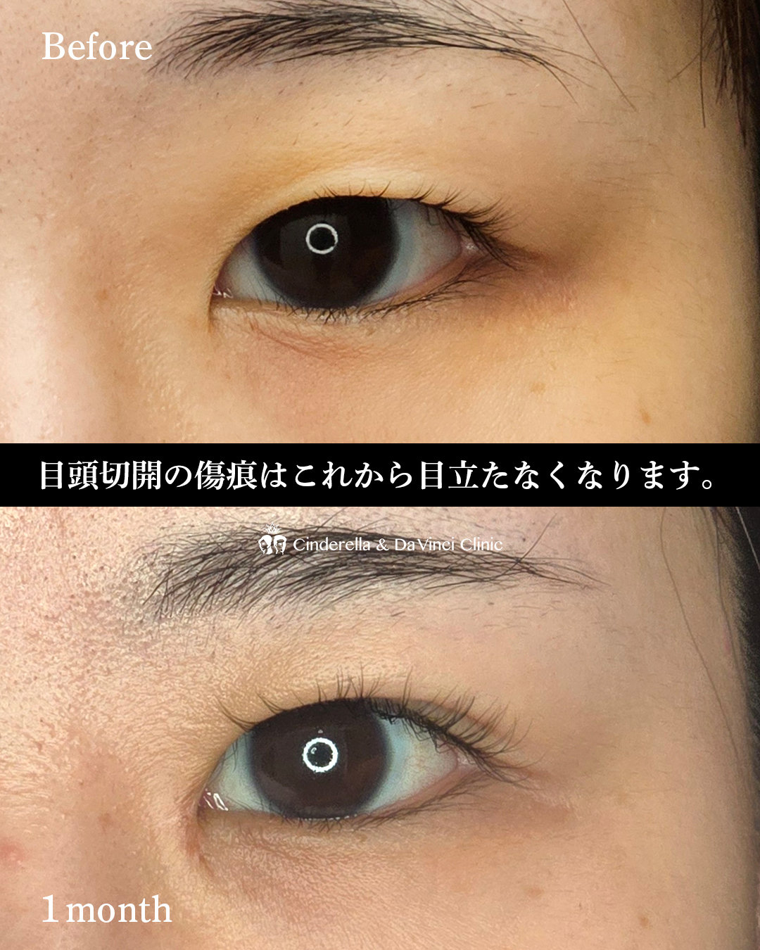 目頭切開で末広二重の画像