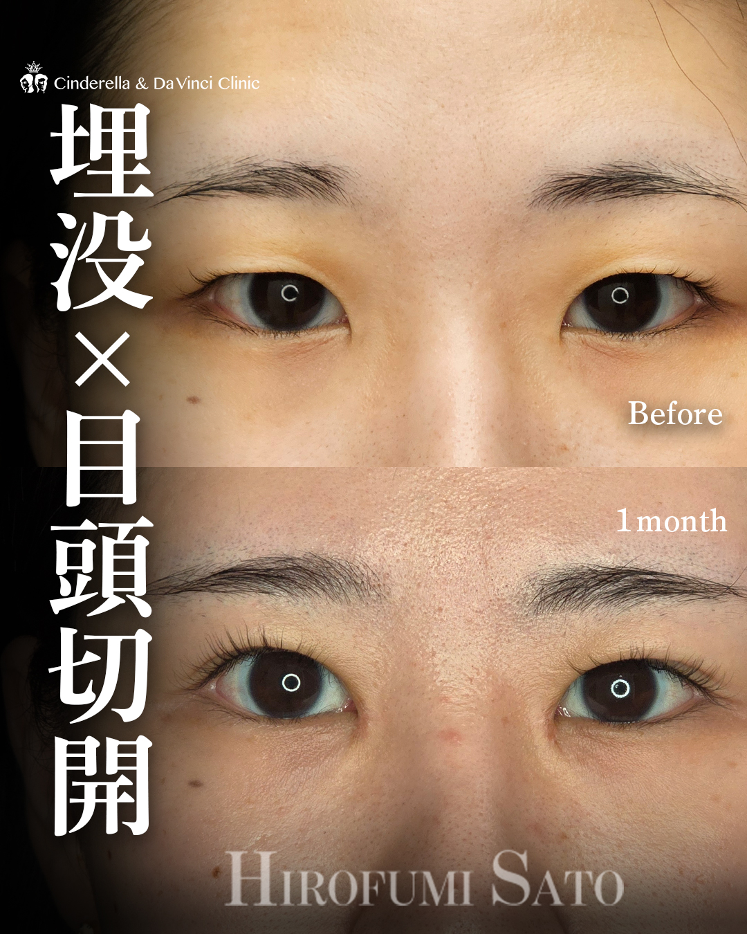 目頭切開で末広二重の画像