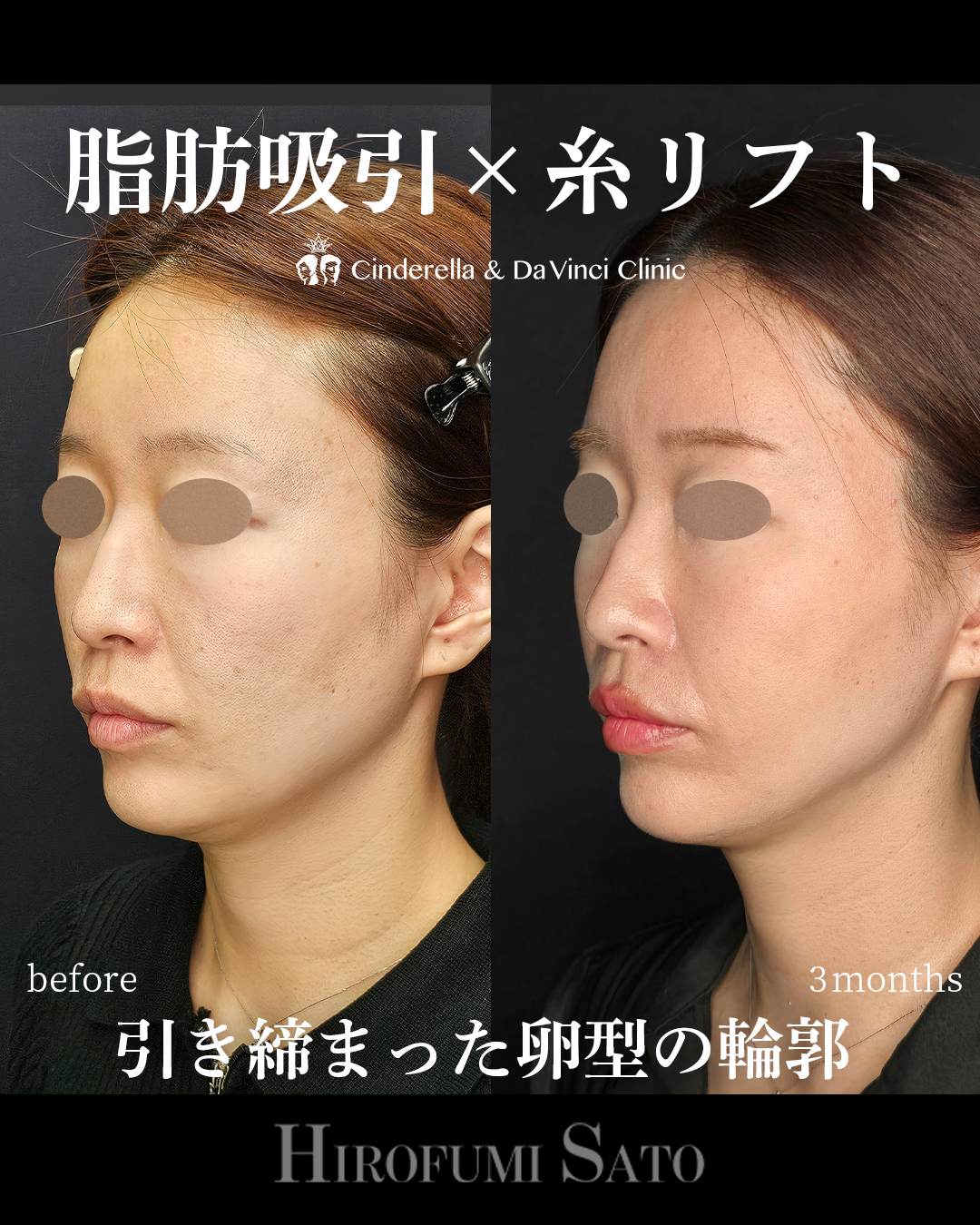 脂肪吸引と糸リフトの画像