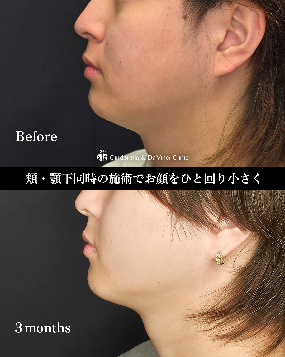 脂肪吸引で顔痩せの画像