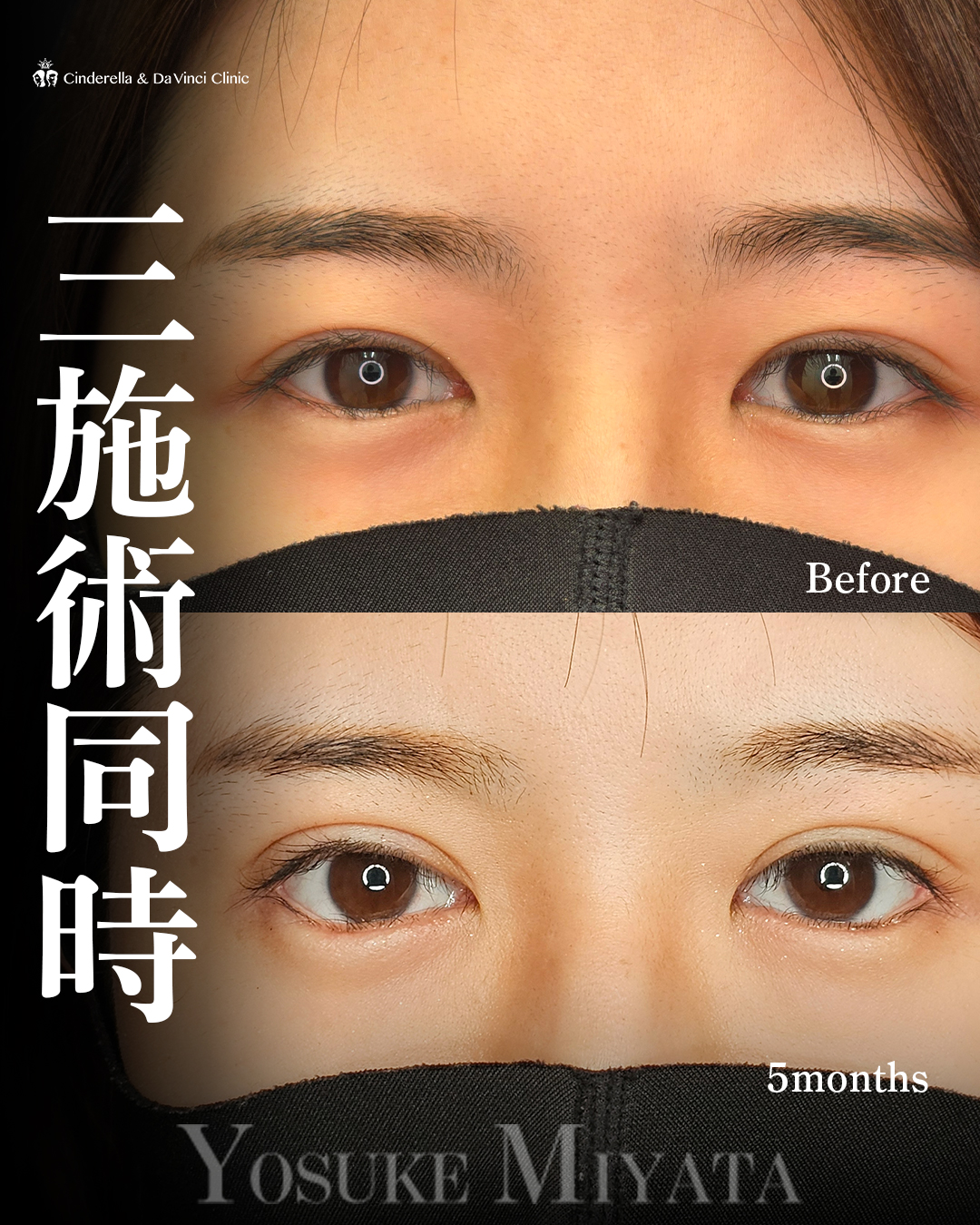 白目の範囲を増やすの画像