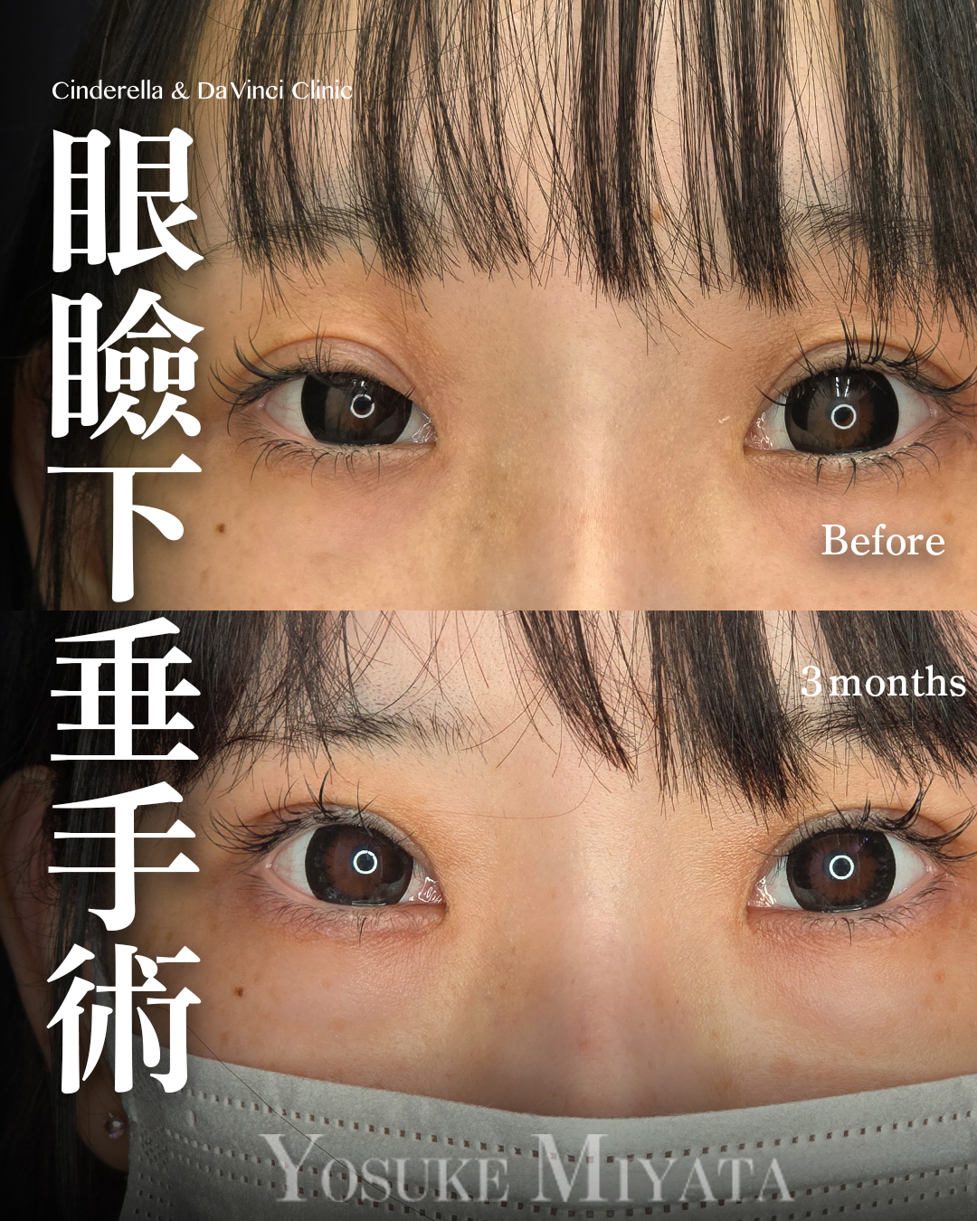 眼瞼下垂手術の画像