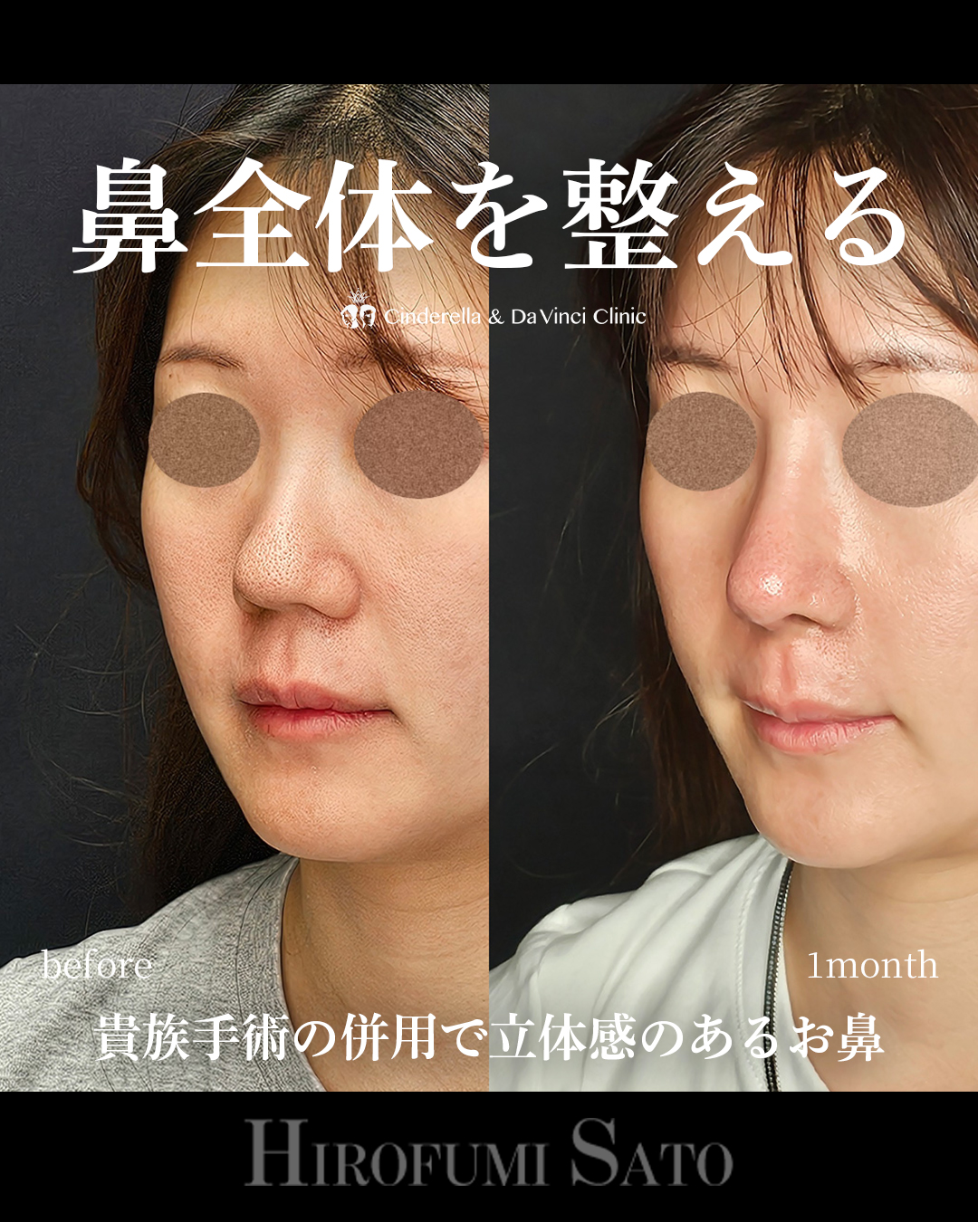 鼻全体を整えるの画像