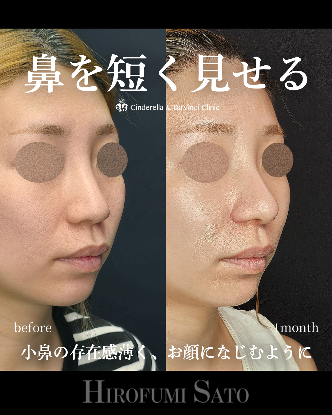 鼻を短く見せるの画像