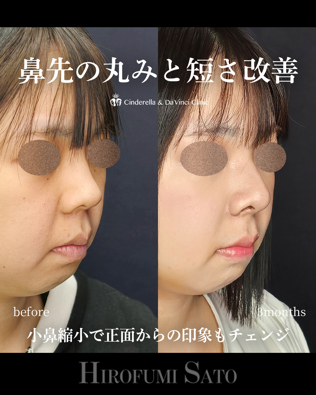 鼻先の丸み改善の画像