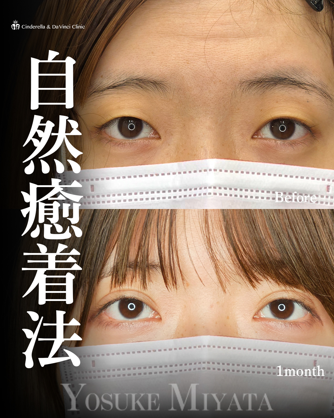 平行二重で美しくの画像
