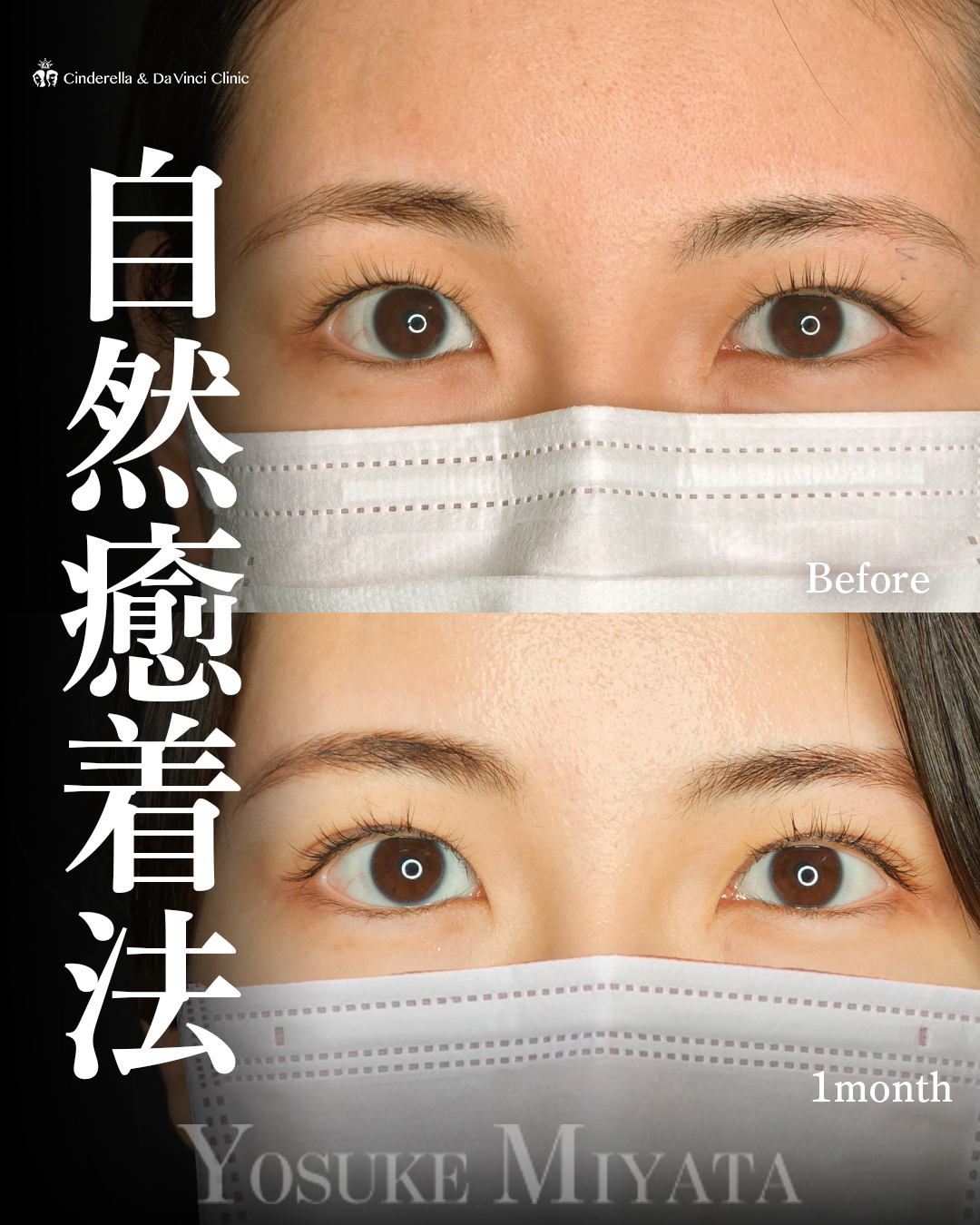 自然で可愛い二重の画像