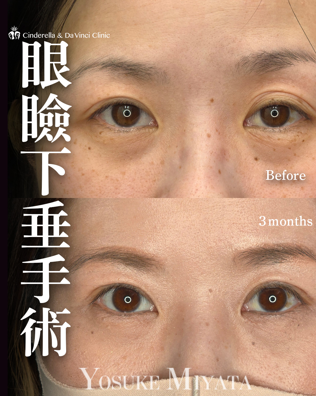 眼瞼下垂手術の画像