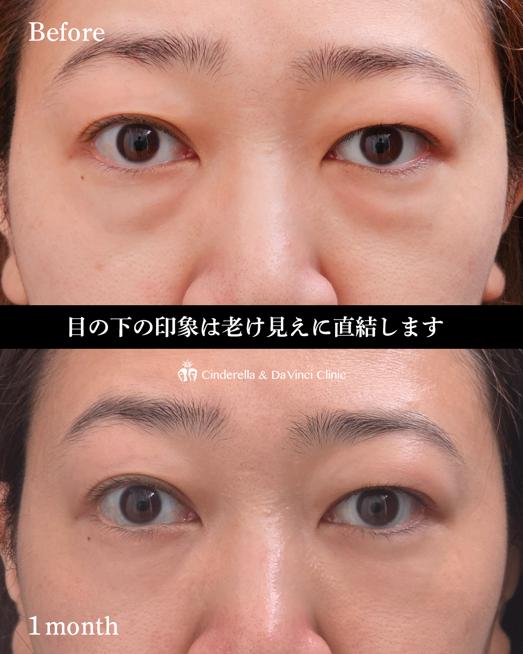 目の下の色ムラ改善の画像