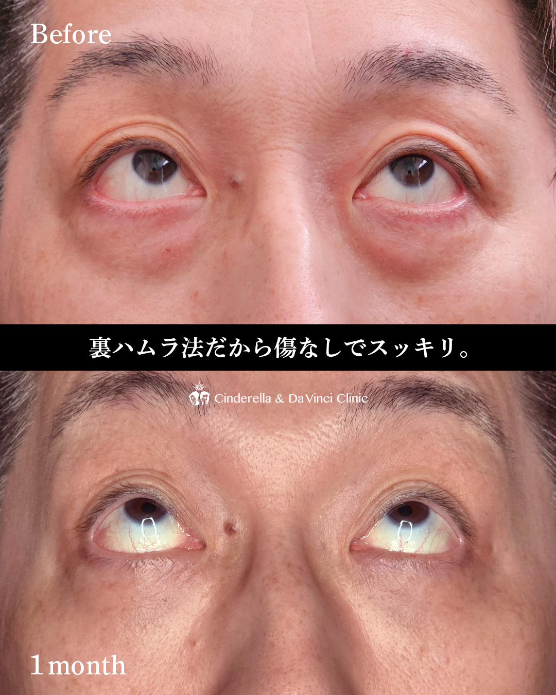 男性のクマ取りの画像