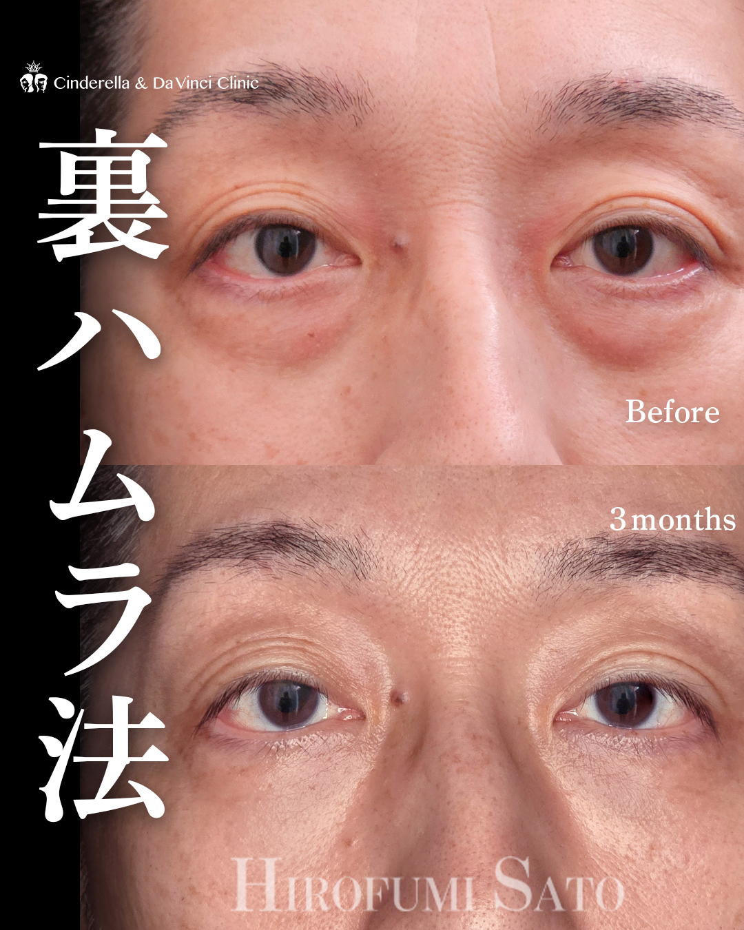 男性のクマ取りの画像