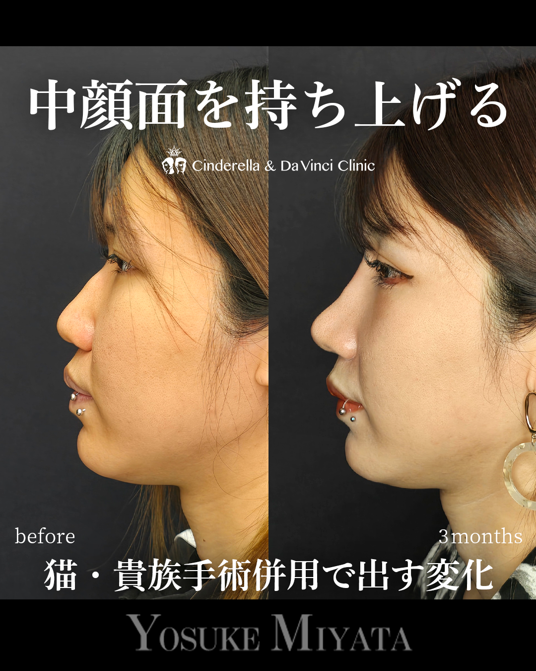 中顔面を持ち上げるの画像
