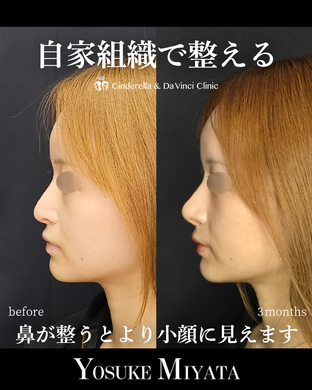 肋軟骨の鼻修正の画像