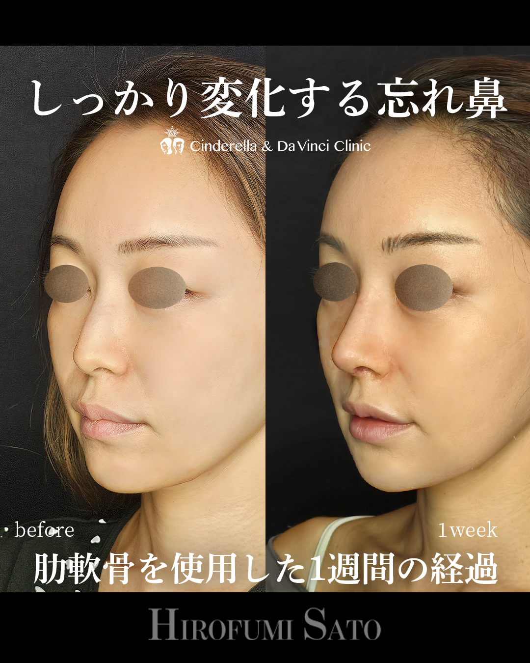 鼻整形1週間の画像