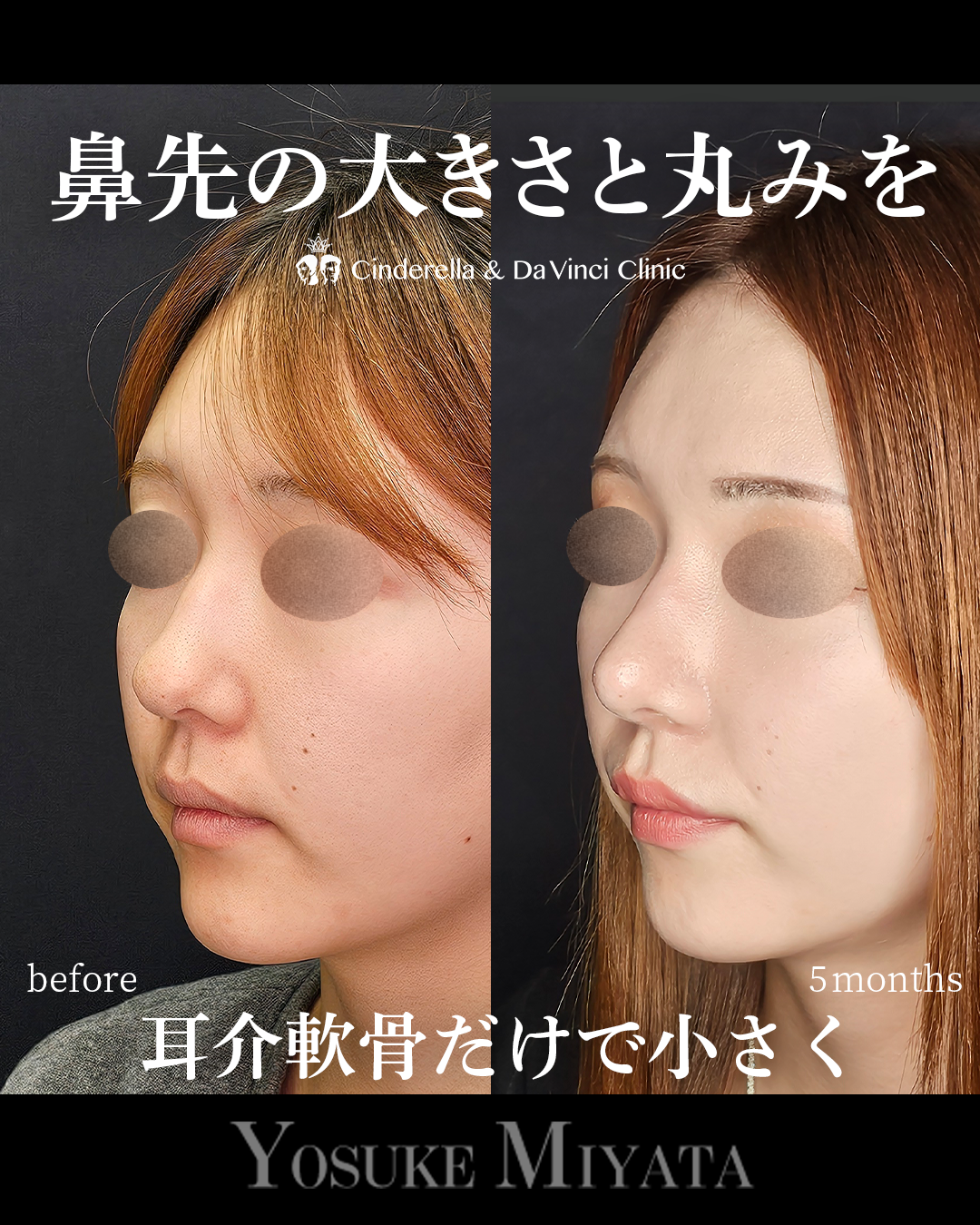 耳軟骨のみの鼻整形の画像