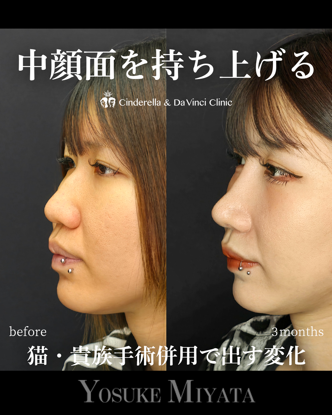 中顔面を持ち上げるの画像