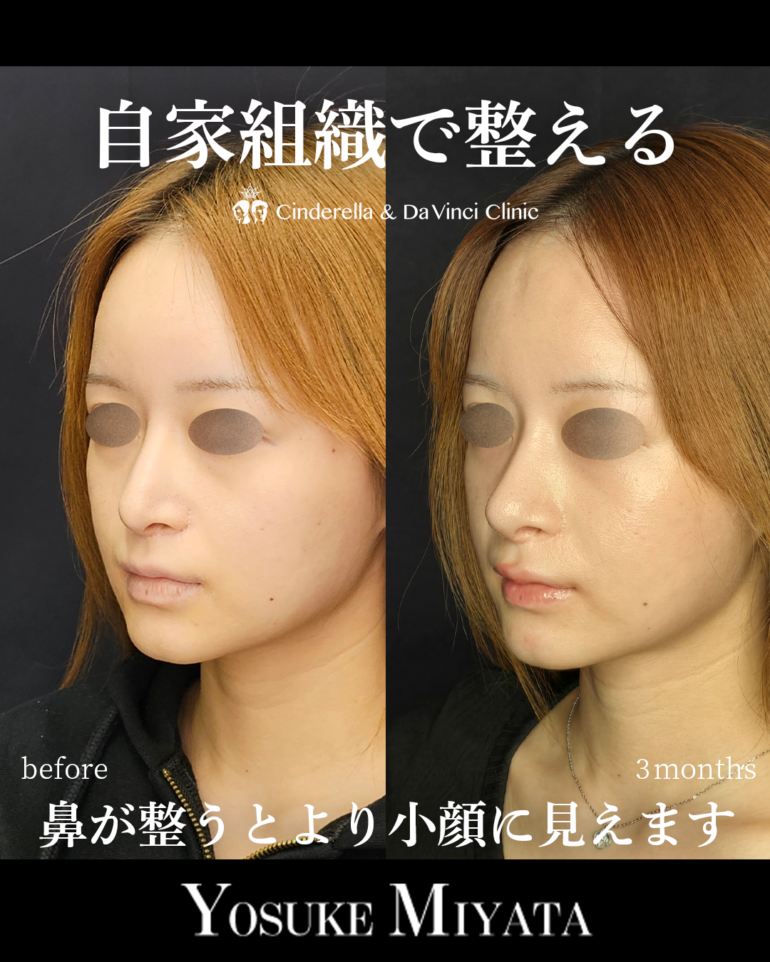 肋軟骨の鼻修正の画像