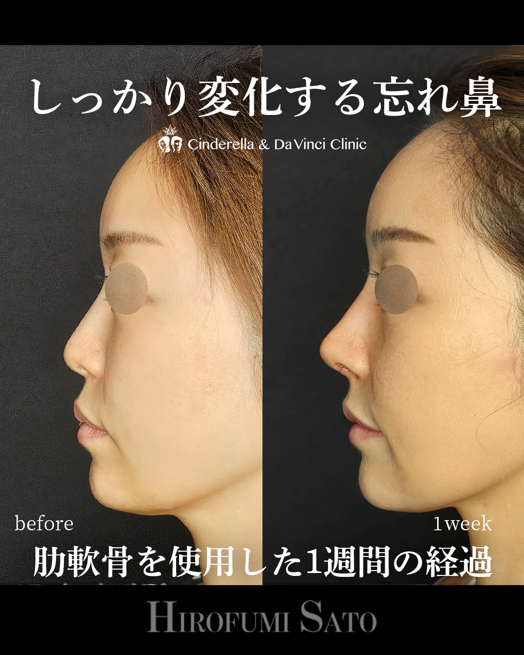 鼻整形1週間の画像
