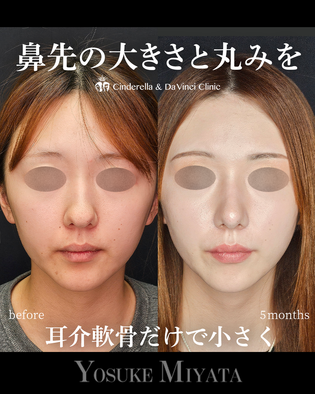 耳軟骨のみの鼻整形の画像