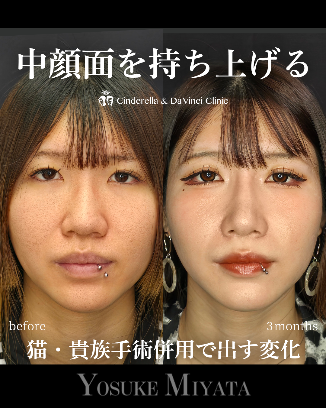 中顔面を持ち上げるの画像