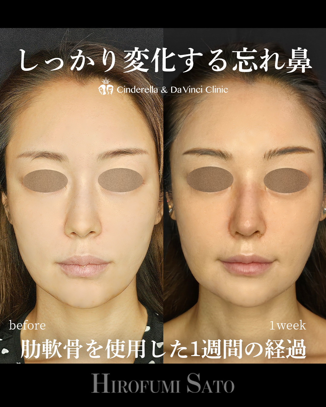 鼻整形1週間の画像