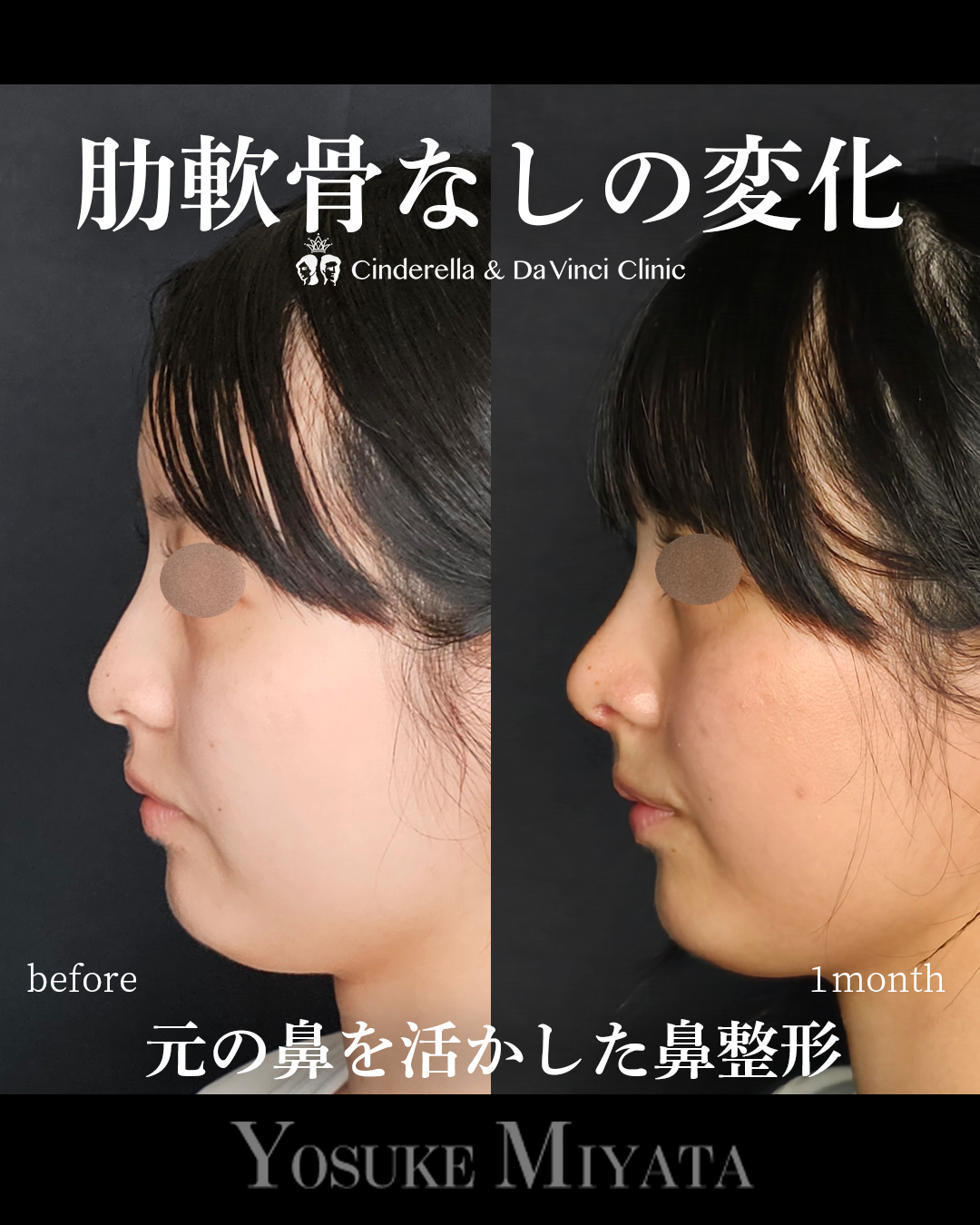 肋軟骨なし鼻整形の画像