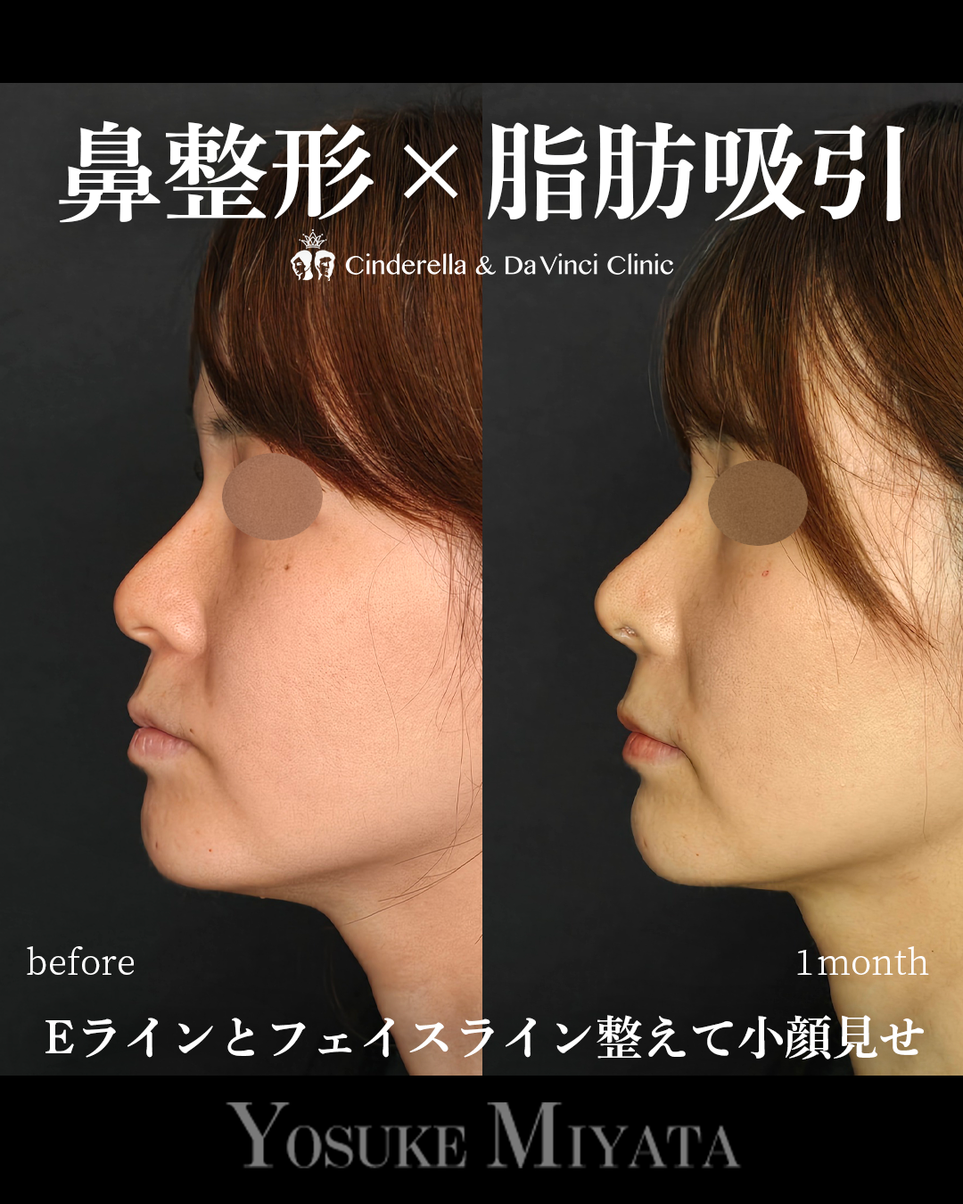 鼻整形と脂肪吸引の画像