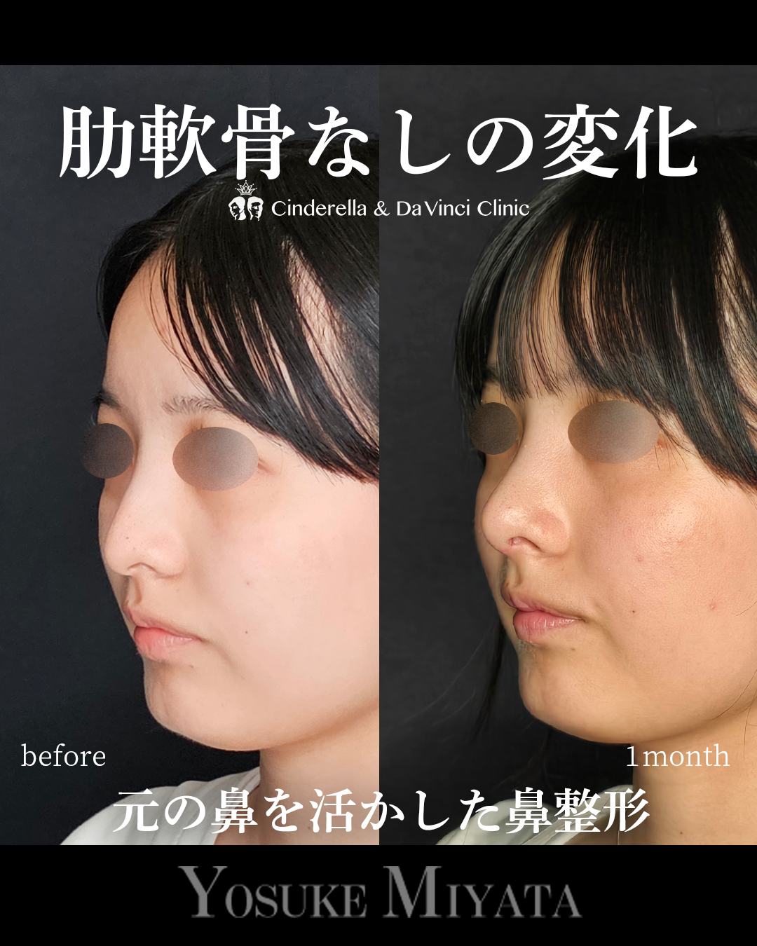 肋軟骨なし鼻整形の画像