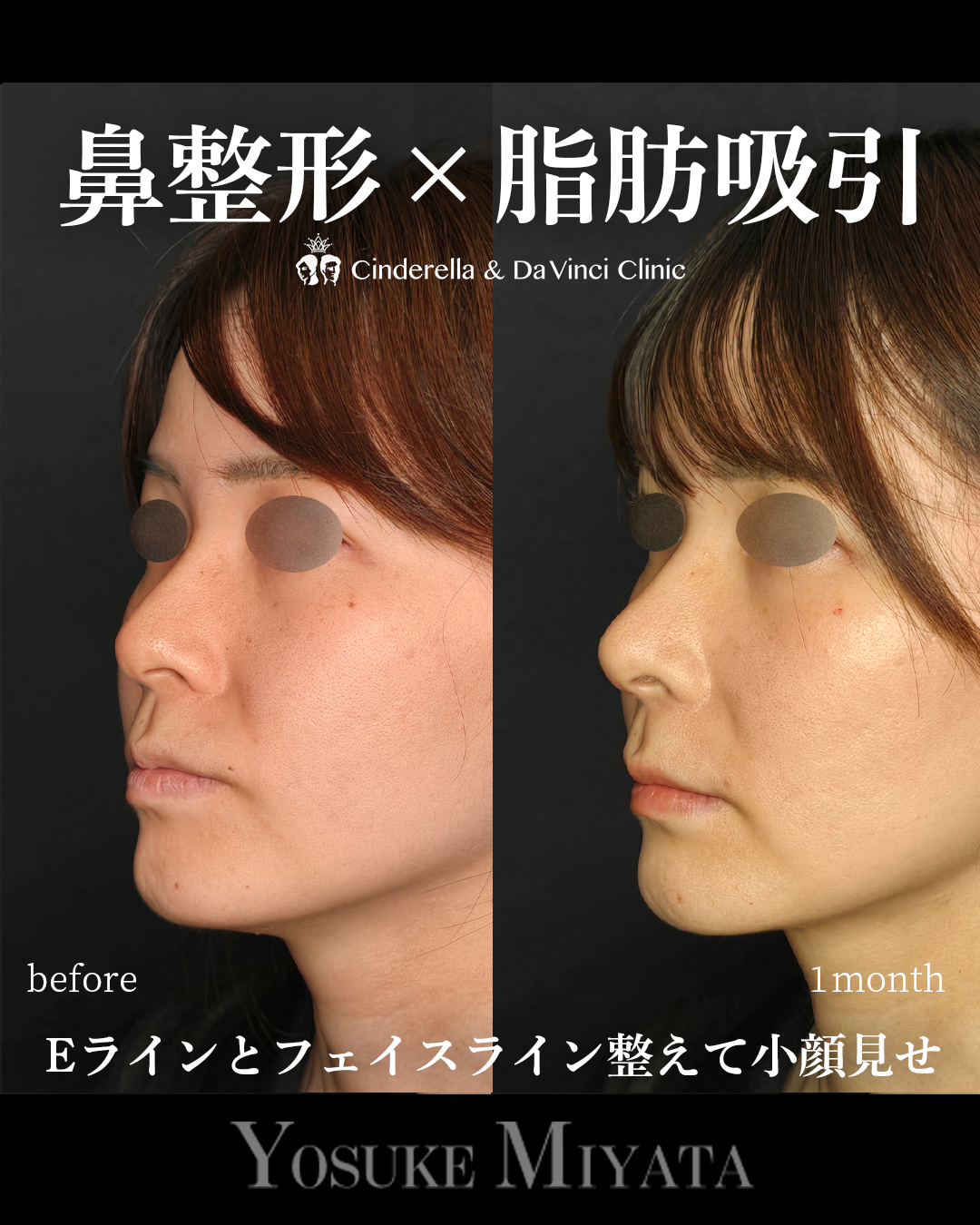 鼻整形と脂肪吸引の画像