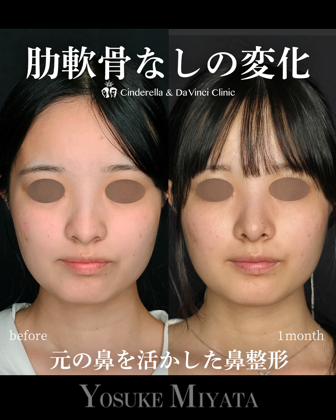 肋軟骨なし鼻整形の画像