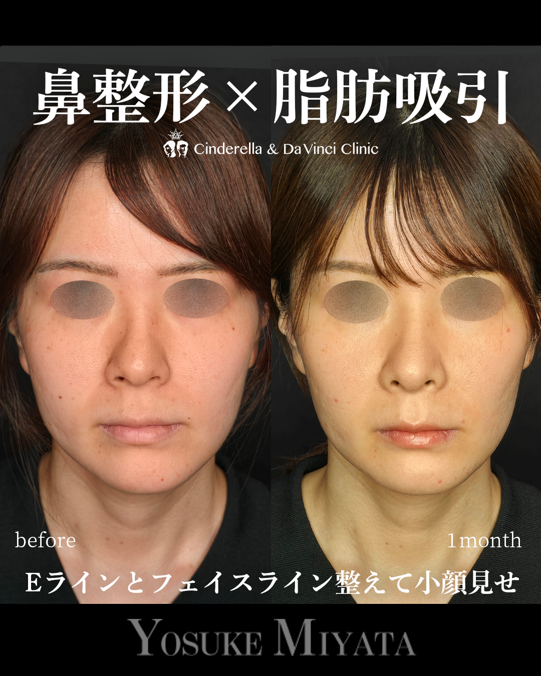 鼻整形と脂肪吸引の画像