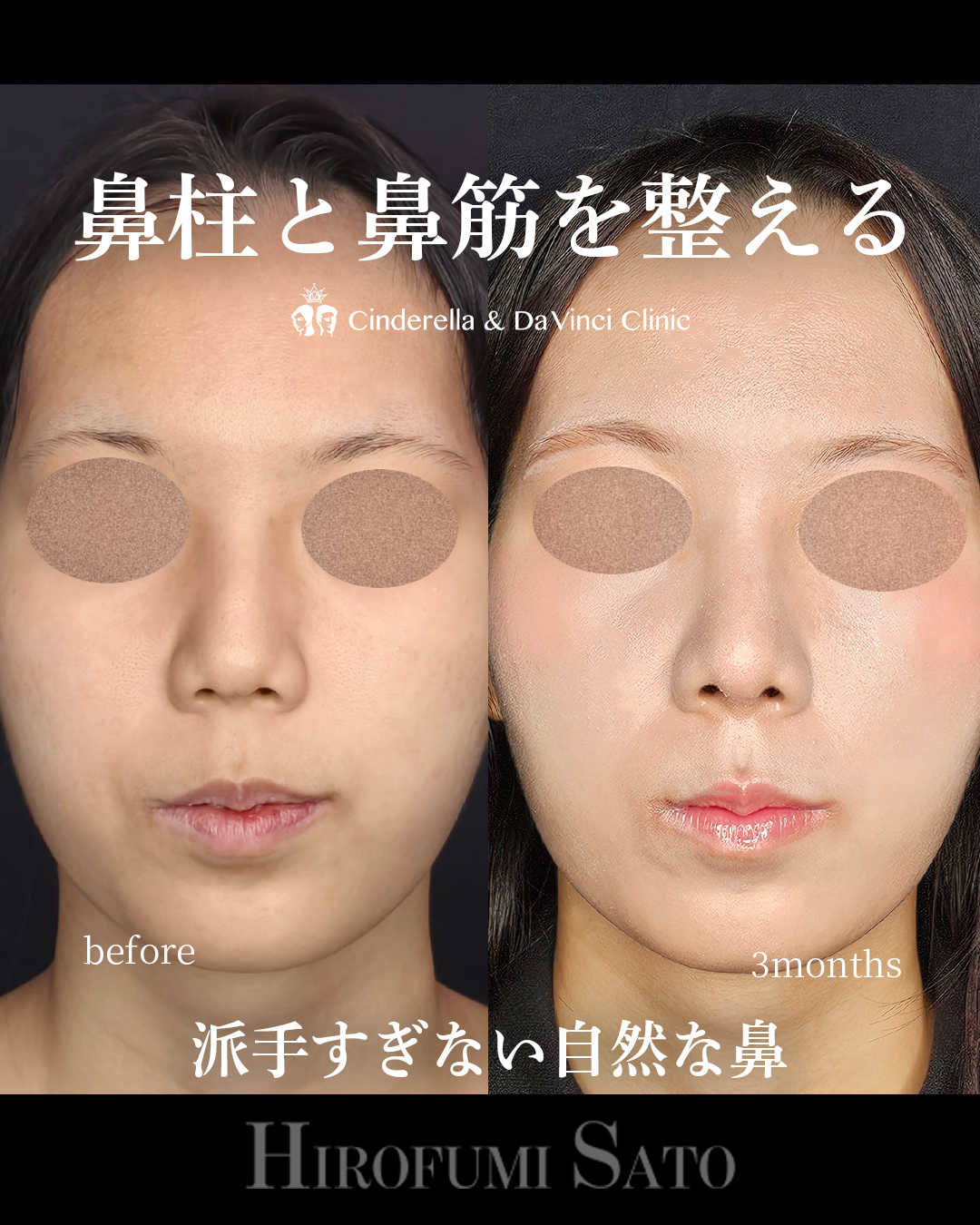 鼻柱と鼻筋を整える | 名古屋の美容外科・美容皮膚科ならCinderella & Da Vinci Clinic【公式】