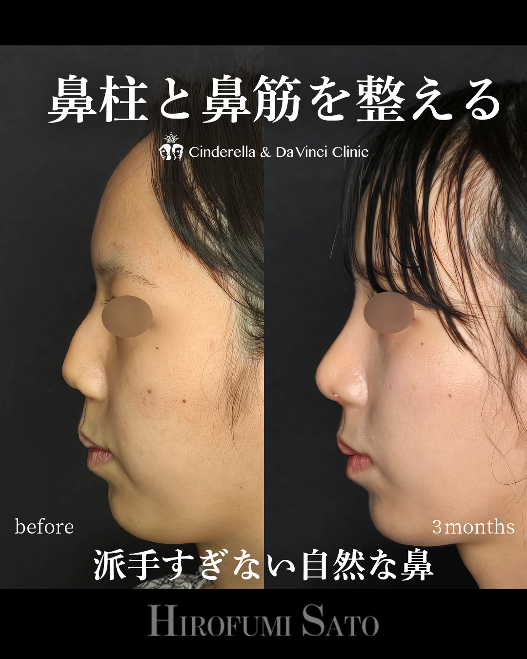 鼻柱と鼻筋を整える | 名古屋の美容外科・美容皮膚科ならCinderella & Da Vinci Clinic【公式】