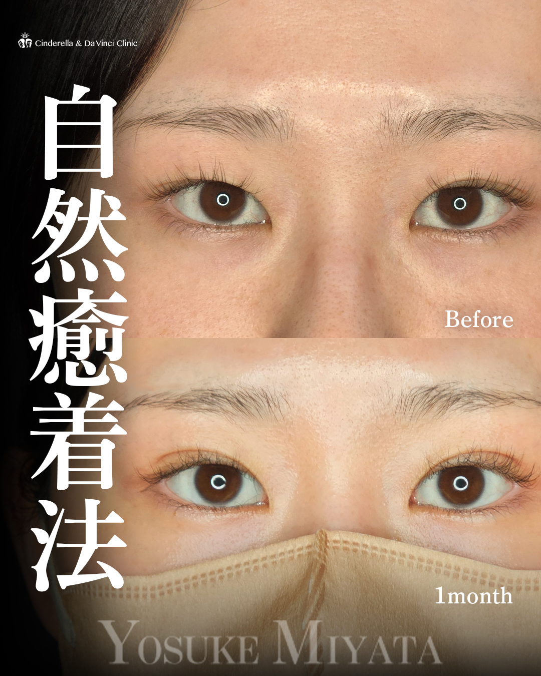 他院埋没留めなおしの画像