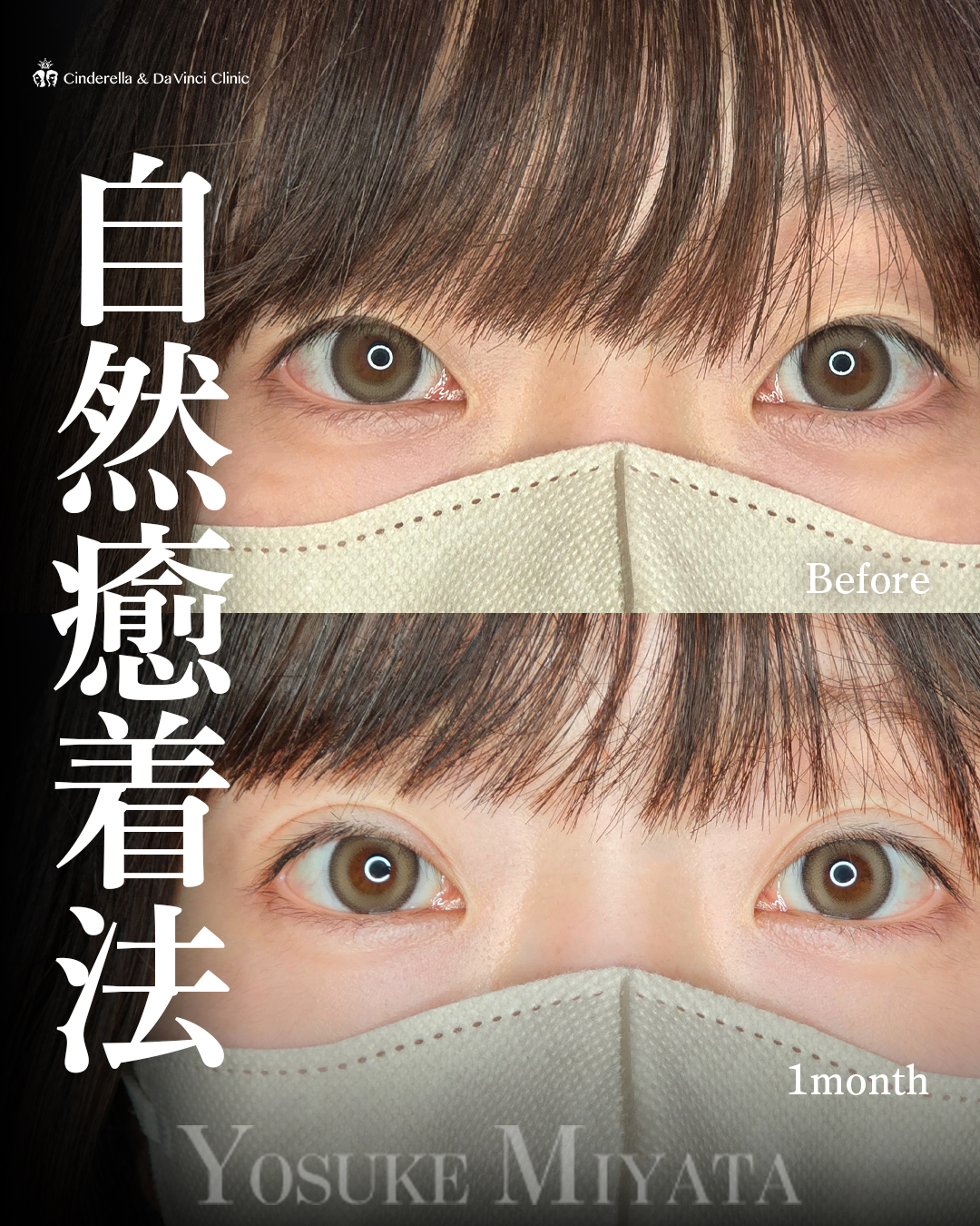 ぱっちり二重の画像