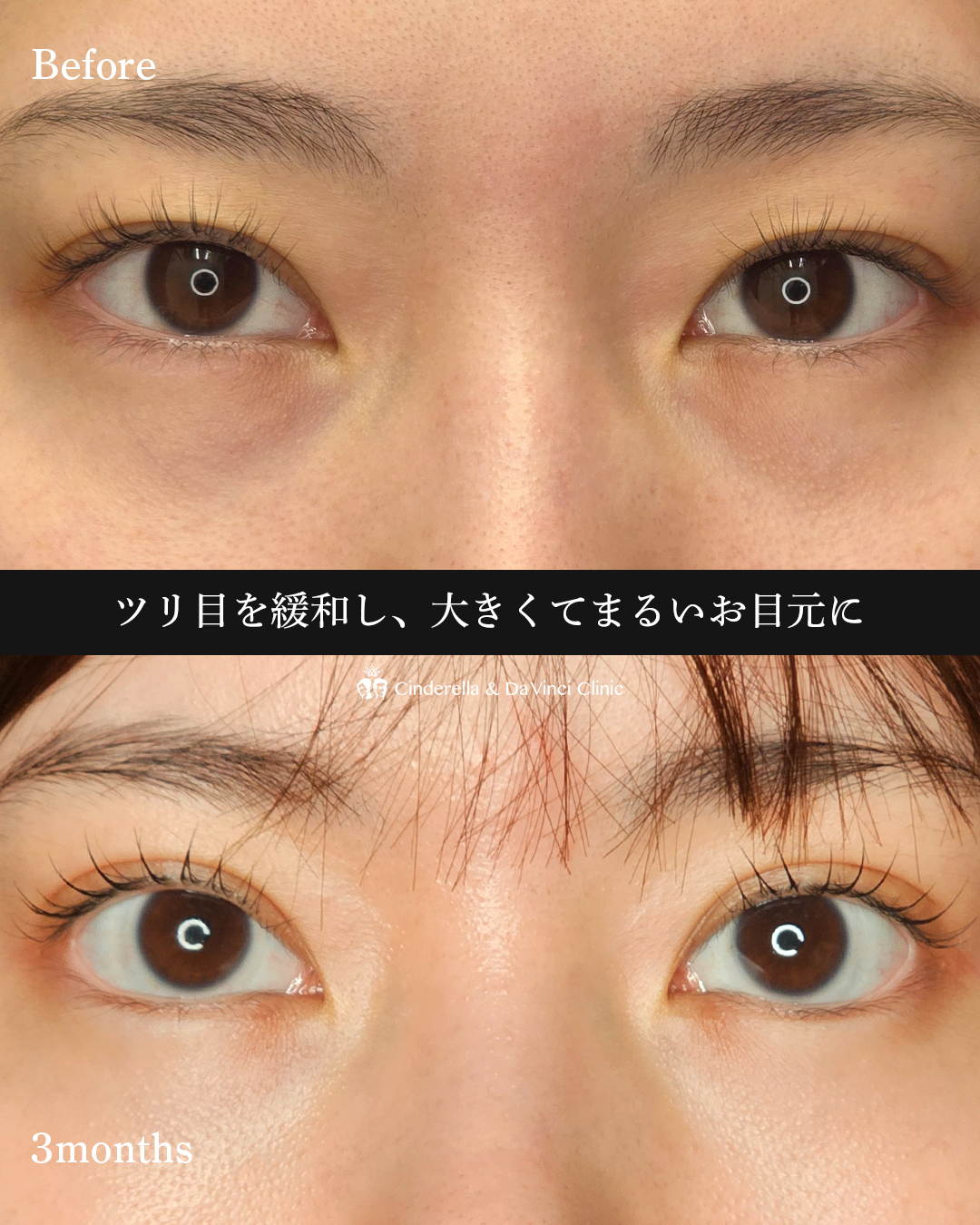 目を大きくするの画像