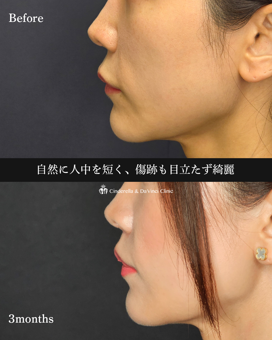 自然に人中短くの画像
