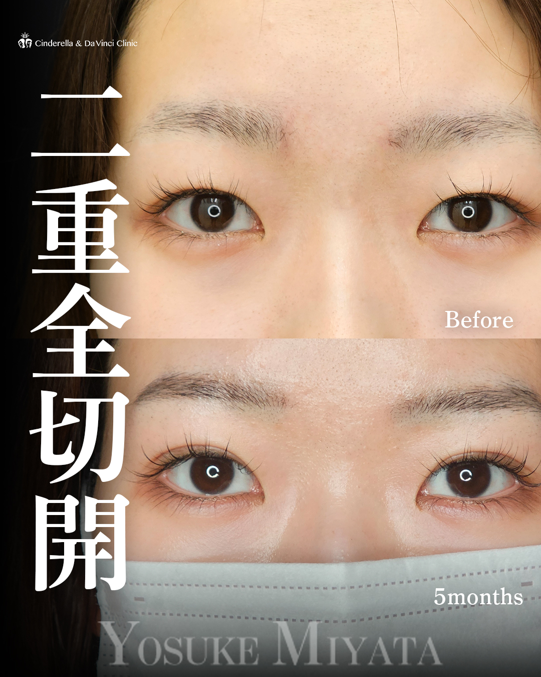 きれいな二重切開の画像
