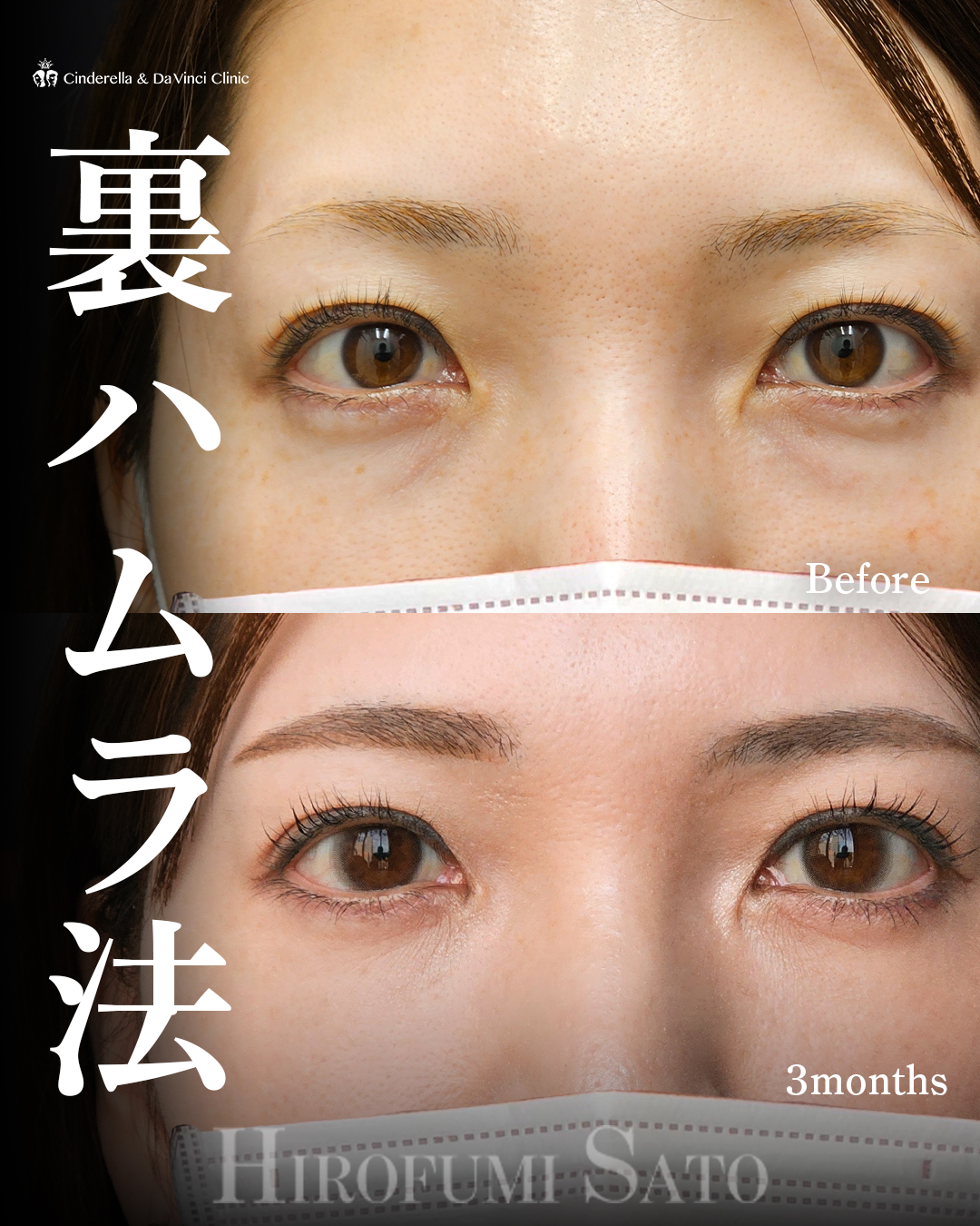 自然なクマ取りの画像