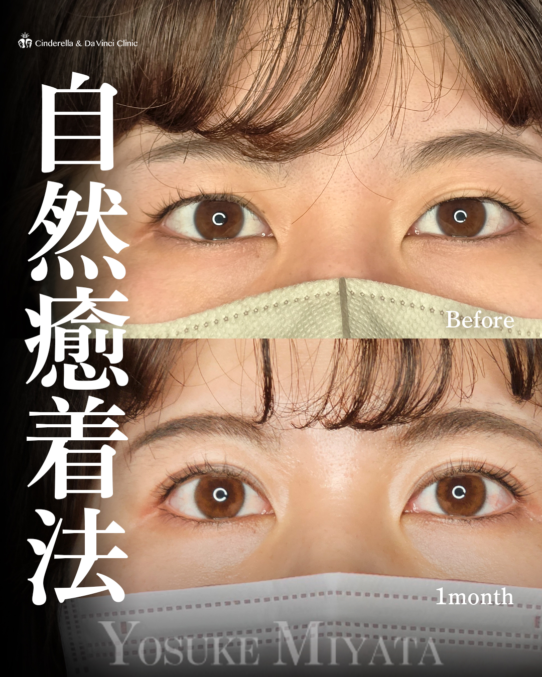 自然な二重の画像