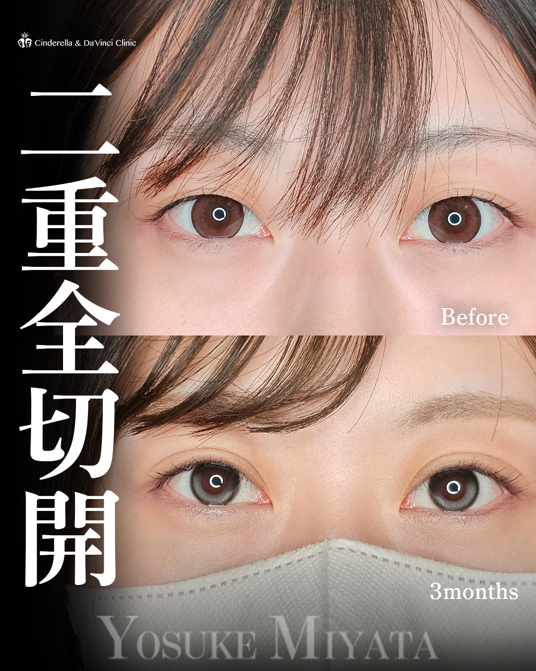 くっきり二重の画像